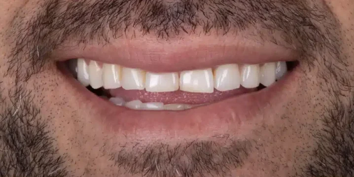 Antes das facetas em zircônia