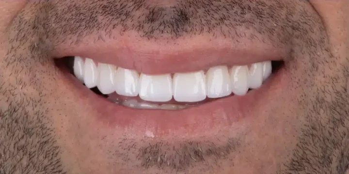 Depois das facetas em zircônia