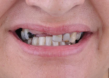 Antes do protocolo sobre implantes