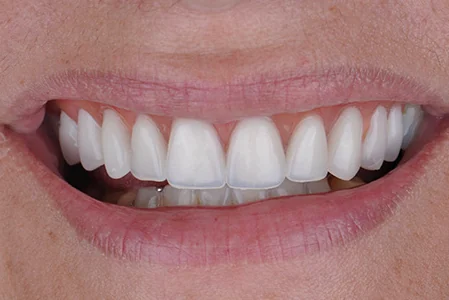 Depois do protocolo sobre implantes