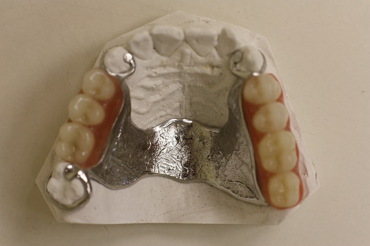 PPR superior pronta com conector maior, grampos, dentes artificiais e base acrílica