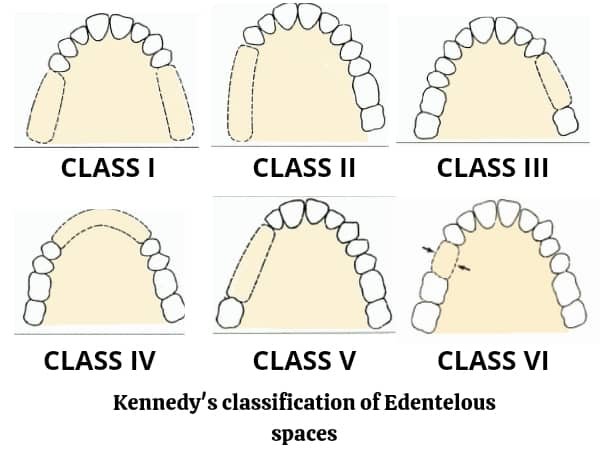 Exemplo didático claro da classificação de Kennedy para arcos parcialmente edêntulos