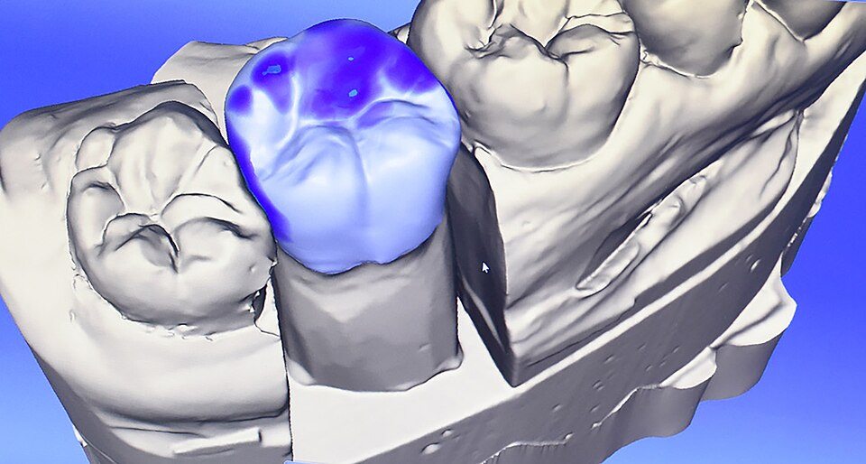 Modelo digital CAD/CAM de coroa sobre escaneamento dental
