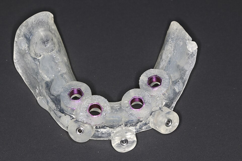 Guia cirúrgico transparente com anilhas metálicas para implantes