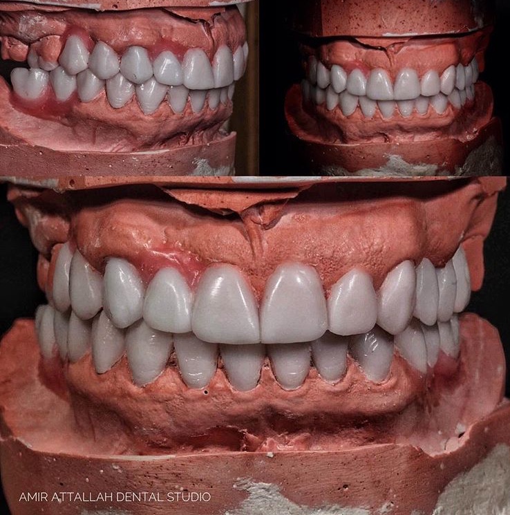 Mock-up diagnóstico em modelo articulado para avaliar forma e volume