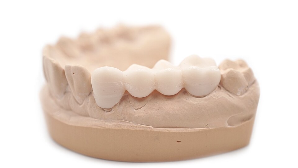 Ponte provisória posicionada em modelo dental